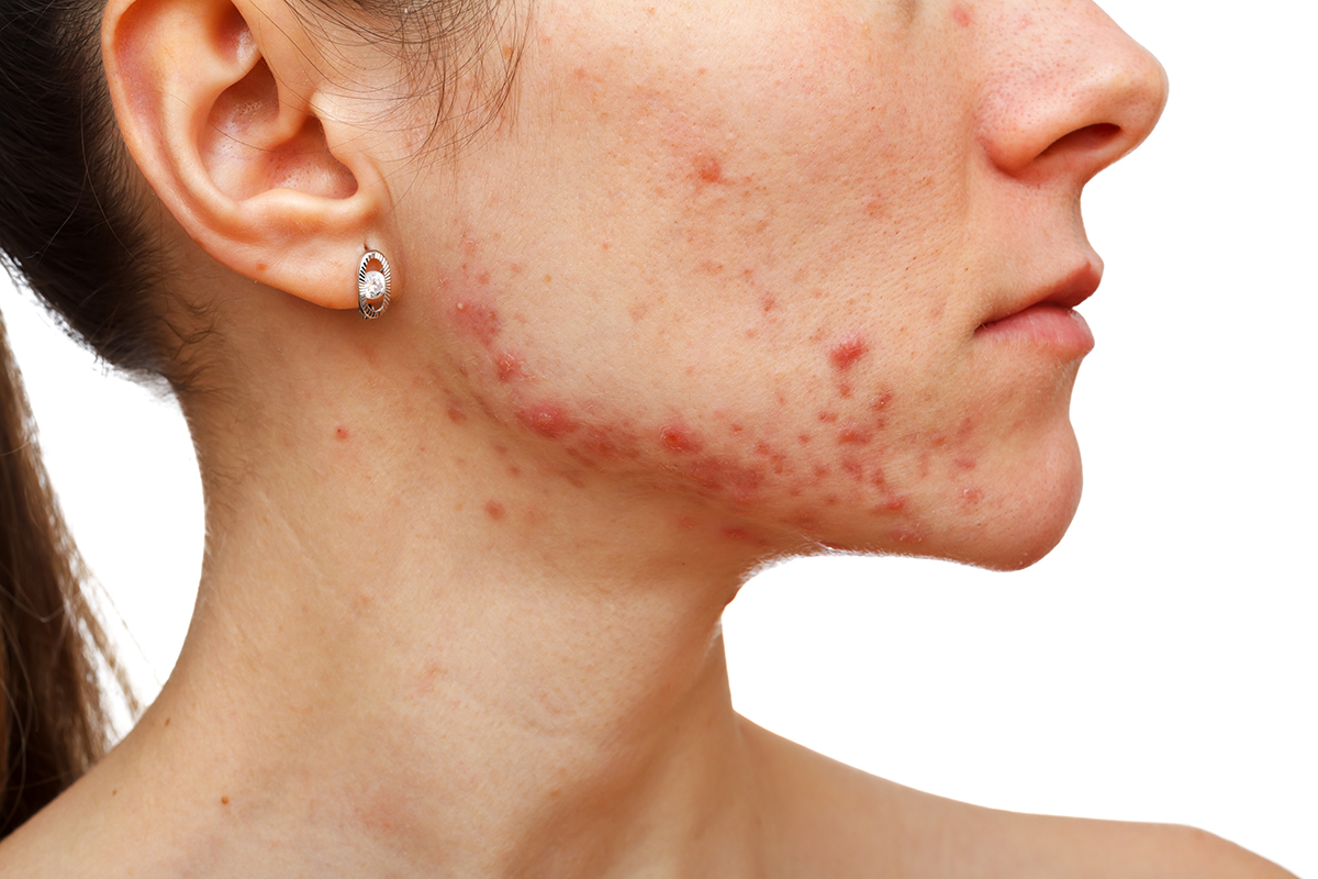 Tratamento para acne e cicatrizes
