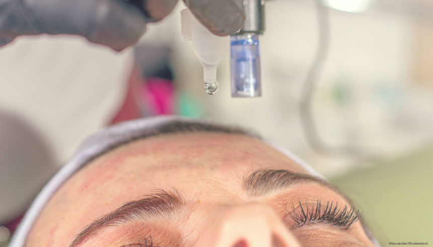 Tratamento eficaz para melasma: conheça o microagulhamento com drug delivery