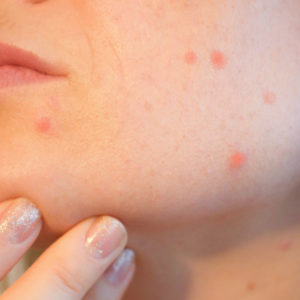 O que é bom para pele oleosa com acne: 7 dicas contra o problema