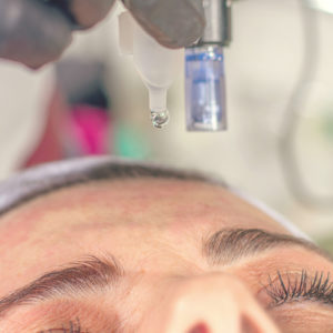 Tratamento eficaz para melasma: conheça o microagulhamento com drug delivery