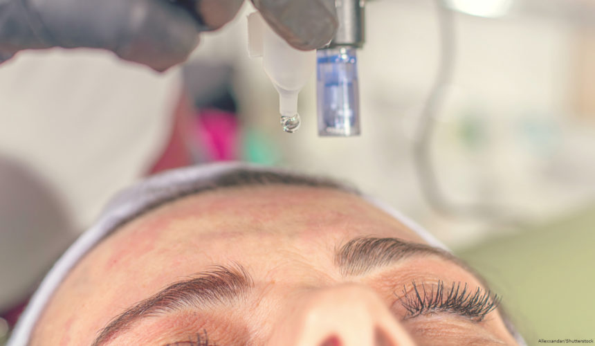 Tratamento eficaz para melasma: conheça o microagulhamento com drug delivery